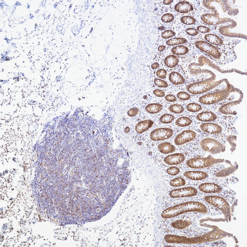 Immunohistochemistry (IHC) staining of human colon tissue using Caspase 3/P17/P19 Recombinant monoclonal antibody (82202-1-RR)