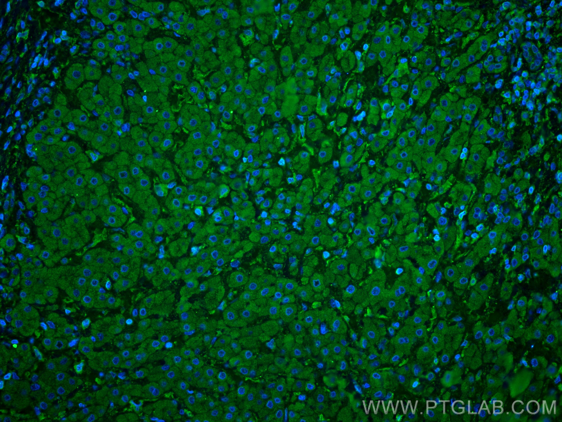 Immunofluorescence (IF) / fluorescent staining of human liver cancer tissue using Caspase 4 Monoclonal antibody (67398-1-Ig)