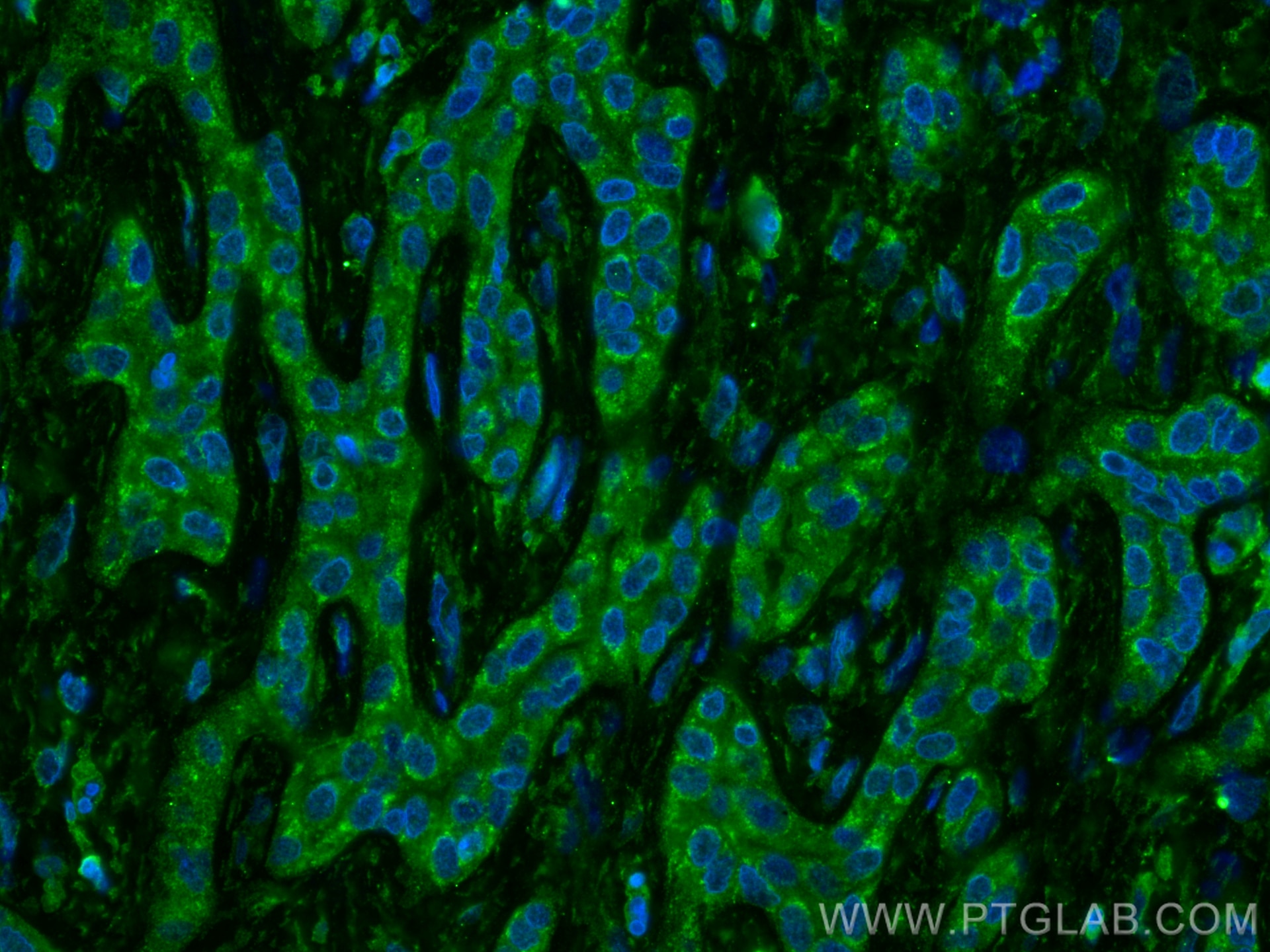 Immunofluorescence (IF) / fluorescent staining of human liver cancer tissue using Caspase 4 Monoclonal antibody (67398-1-Ig)