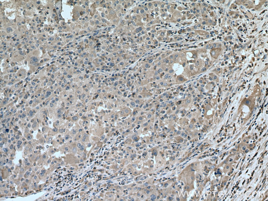 Immunohistochemistry (IHC) staining of human liver cancer tissue using Caspase 4 Monoclonal antibody (67398-1-Ig)
