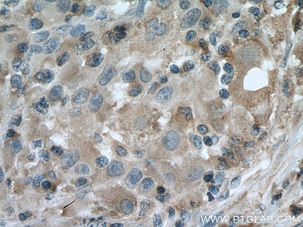 Immunohistochemistry (IHC) staining of human liver cancer tissue using Caspase 4 Monoclonal antibody (67398-1-Ig)