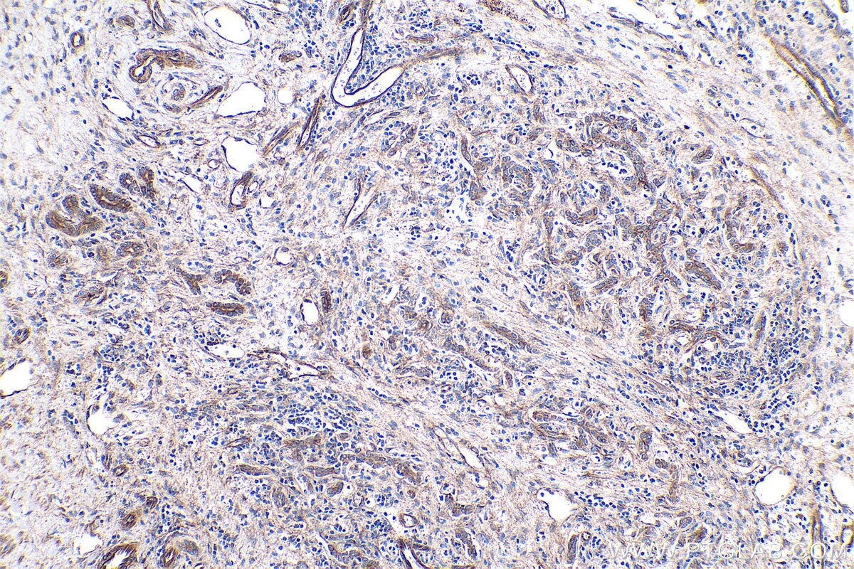 Immunohistochemistry (IHC) staining of human liver cancer tissue using Caspase 7 Monoclonal antibody (67956-1-Ig)