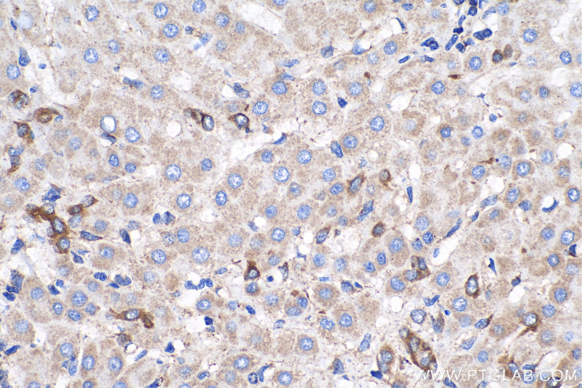 Immunohistochemistry (IHC) staining of human liver cancer tissue using Caspase 7 Monoclonal antibody (67956-1-Ig)