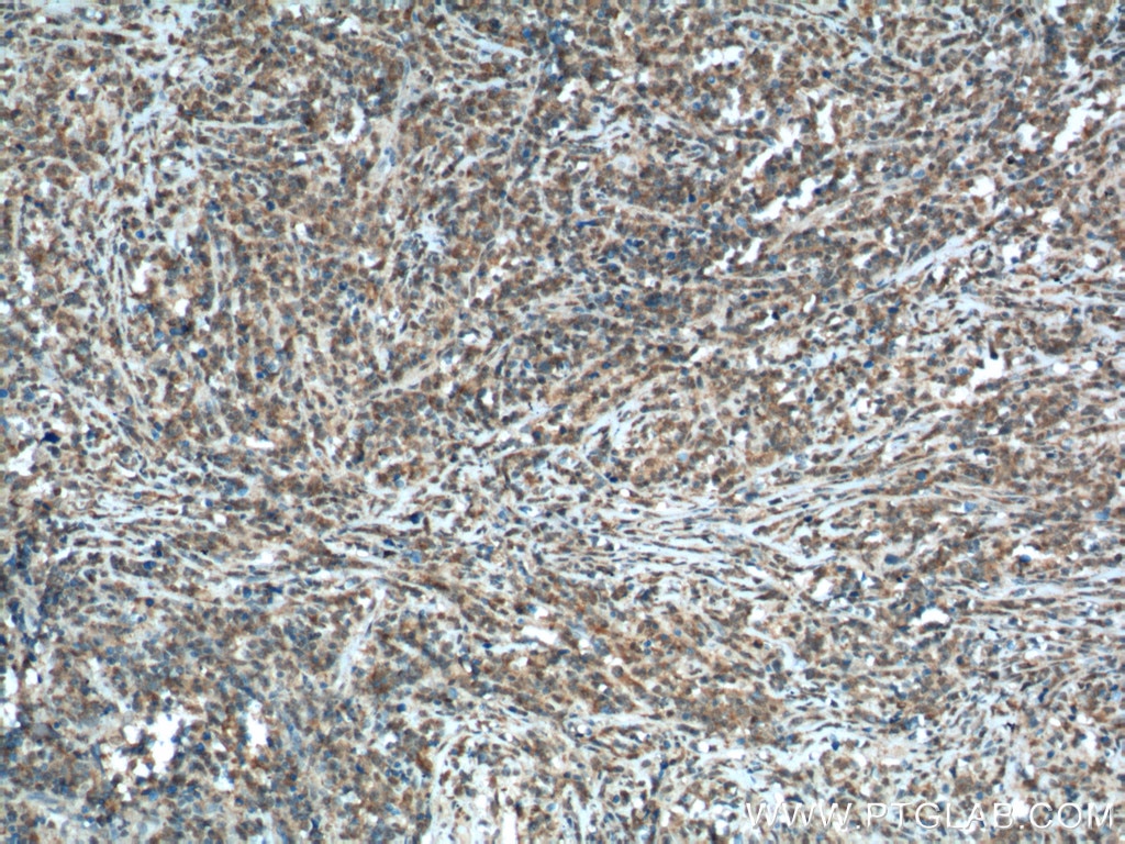 Immunohistochemistry (IHC) staining of human lymphoma tissue using Caspase 9/p35/p10 Monoclonal antibody (66169-1-Ig)