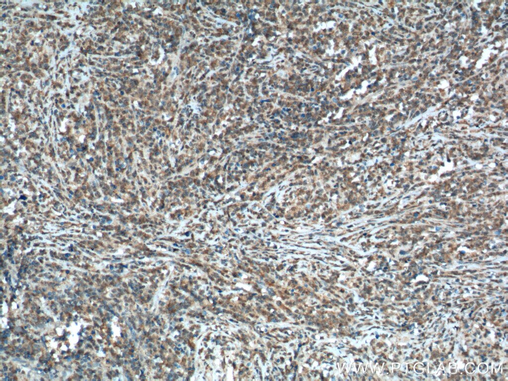 IHC staining of human lymphoma using 66169-1-Ig