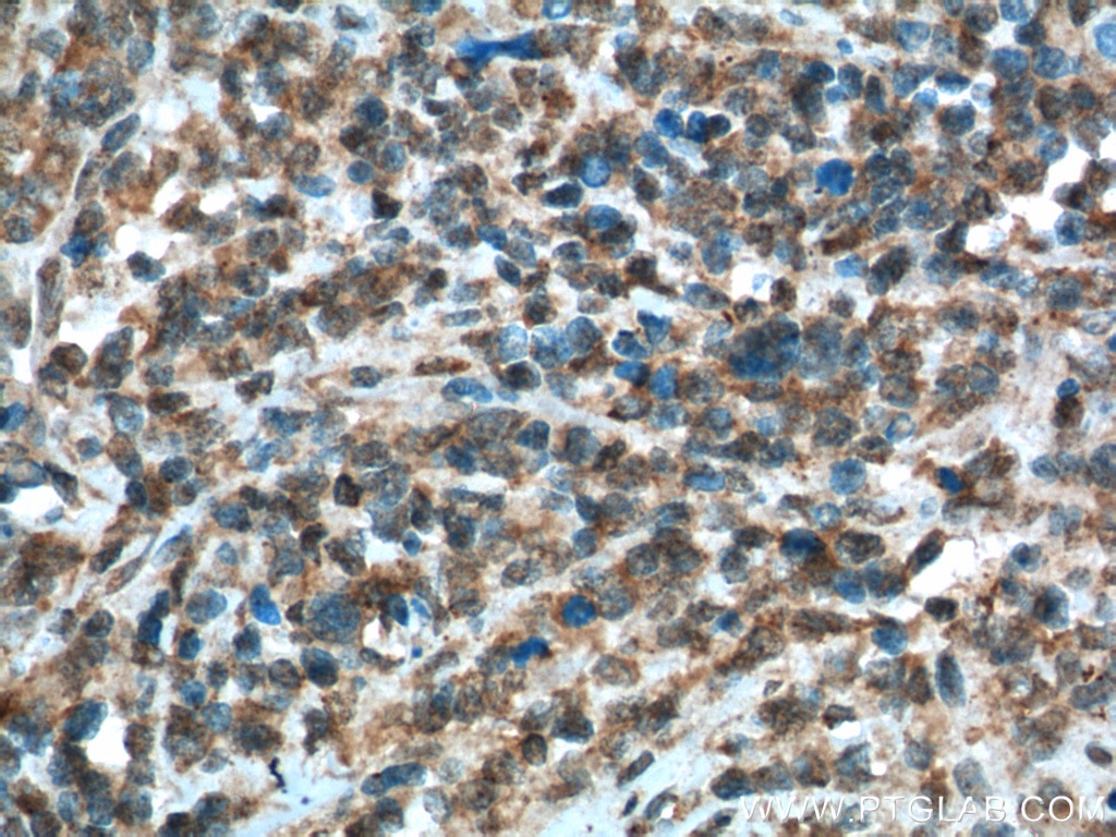 Immunohistochemistry (IHC) staining of human lymphoma tissue using Caspase 9/p35/p10 Monoclonal antibody (66169-1-Ig)