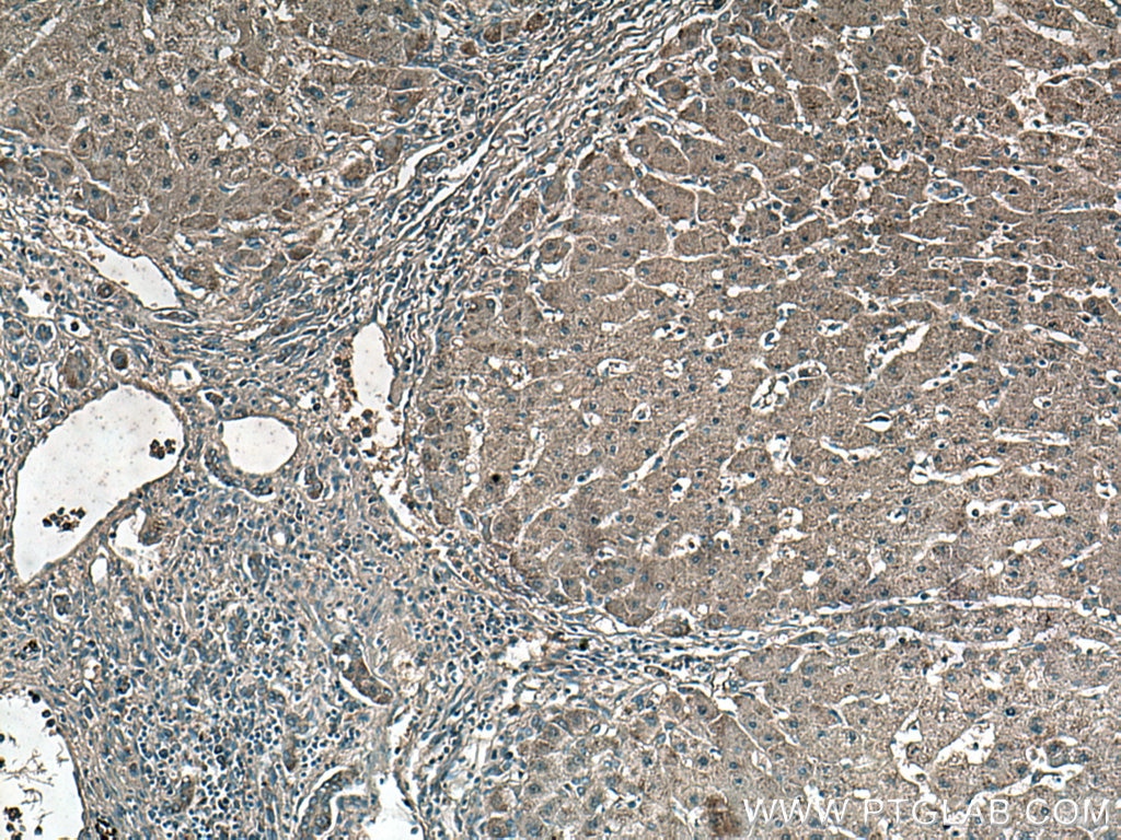 Immunohistochemistry (IHC) staining of human hepatocirrhosis tissue using Catalase Monoclonal antibody (66765-1-Ig)