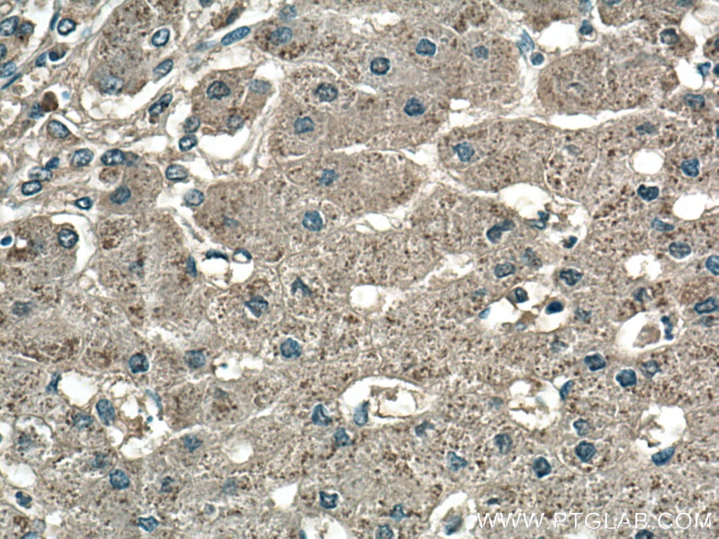 Immunohistochemistry (IHC) staining of human hepatocirrhosis tissue using Catalase Monoclonal antibody (66765-1-Ig)