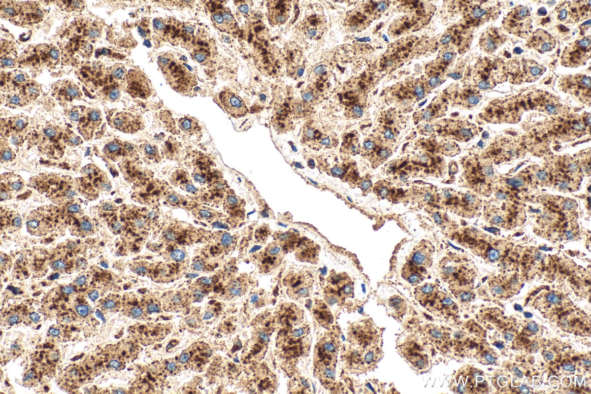 Immunohistochemical analysis of paraffin-embedded human liver tissue slide using 31516-1-AP (Cathepsin D antibody) at dilution of 1:400 (under 40x lens). Heat mediated antigen retrieval with Tris-EDTA buffer (pH 9.0). Immunohistochemistry (IHC) staining of human liver tissue using Cathepsin D Polyclonal antibody (31516-1-AP)
