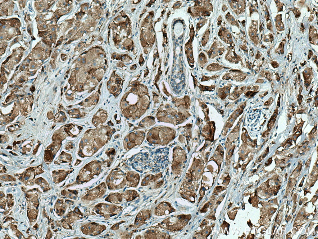 IHC staining of human breast cancer using 66534-1-Ig