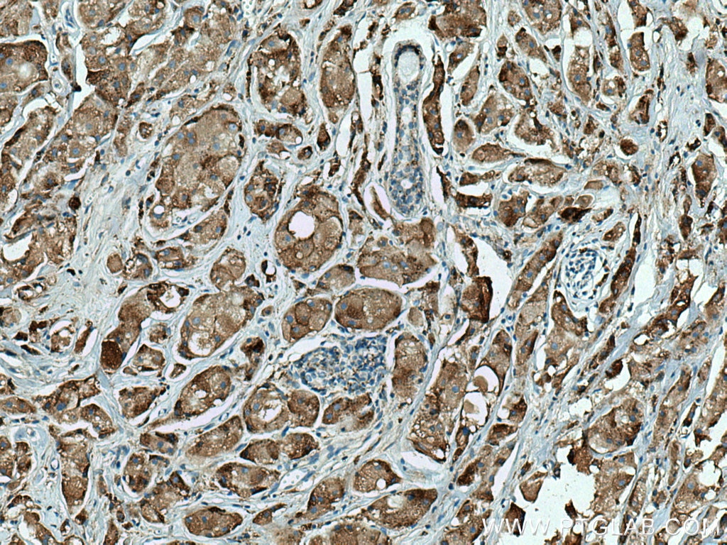 Immunohistochemistry (IHC) staining of human breast cancer tissue using Cathepsin D Monoclonal antibody (66534-1-Ig)