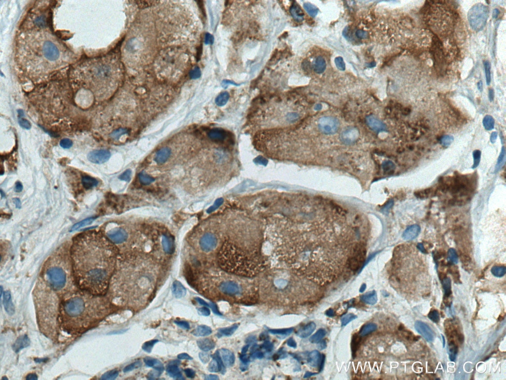 Immunohistochemistry (IHC) staining of human breast cancer tissue using Cathepsin D Monoclonal antibody (66534-1-Ig)