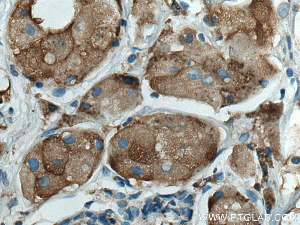 IHC staining of human breast cancer using 66534-1-Ig