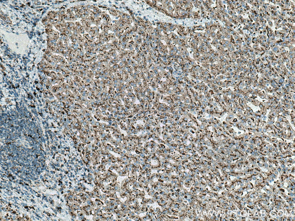 Immunohistochemistry (IHC) staining of human liver cancer tissue using Cathepsin D Monoclonal antibody (66534-1-Ig)