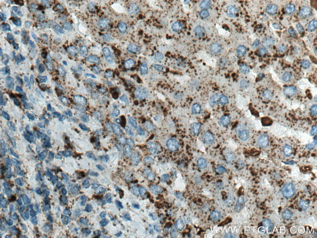 Immunohistochemistry (IHC) staining of human liver cancer tissue using Cathepsin D Monoclonal antibody (66534-1-Ig)