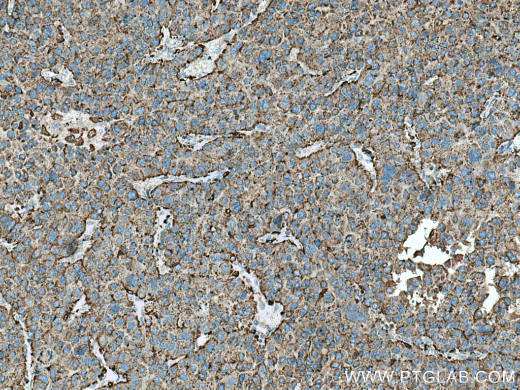 IHC staining of human liver cancer using 66534-1-Ig