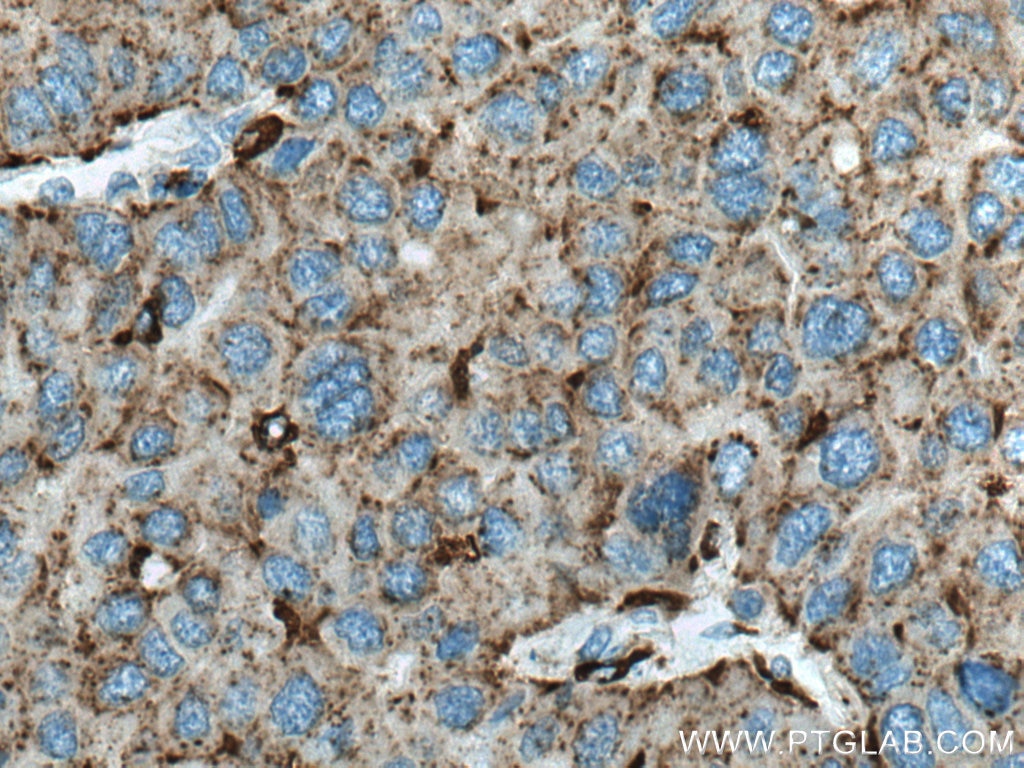 IHC staining of human liver cancer using 66534-1-Ig