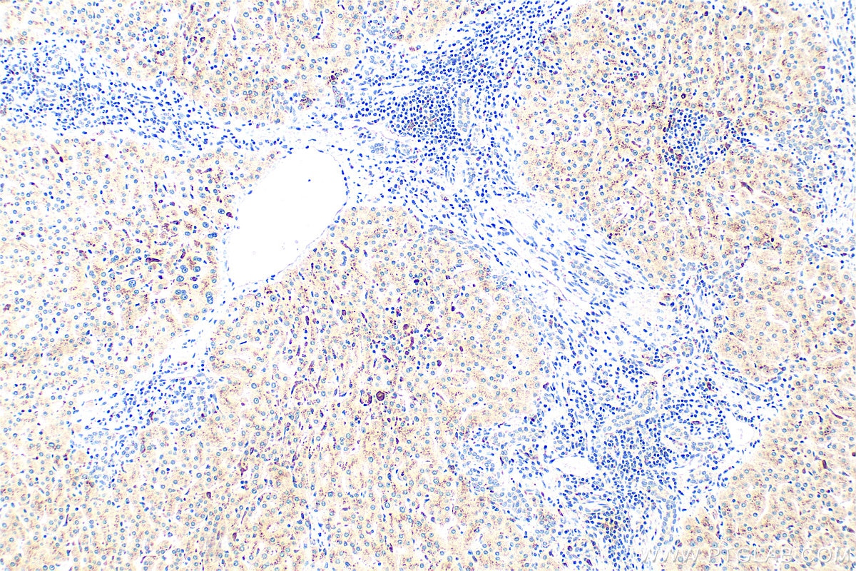 IHC staining of human hepatocirrhosis using RMX00012 Immunohistochemistry (IHC) staining of human hepatocirrhosis tissue using Multi-rAb® Cathepsin D Multi-Recombinant antibody (RMX00012)