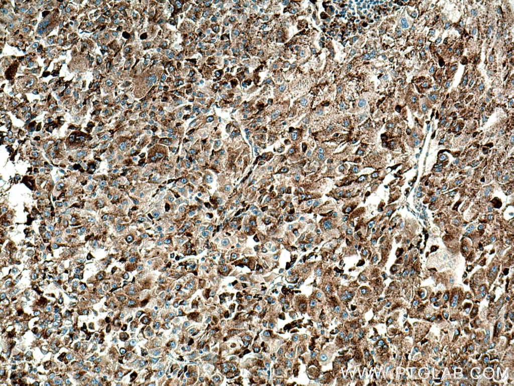 Immunohistochemistry (IHC) staining of human liver cancer tissue using Cathepsin L Polyclonal antibody (27952-1-AP)