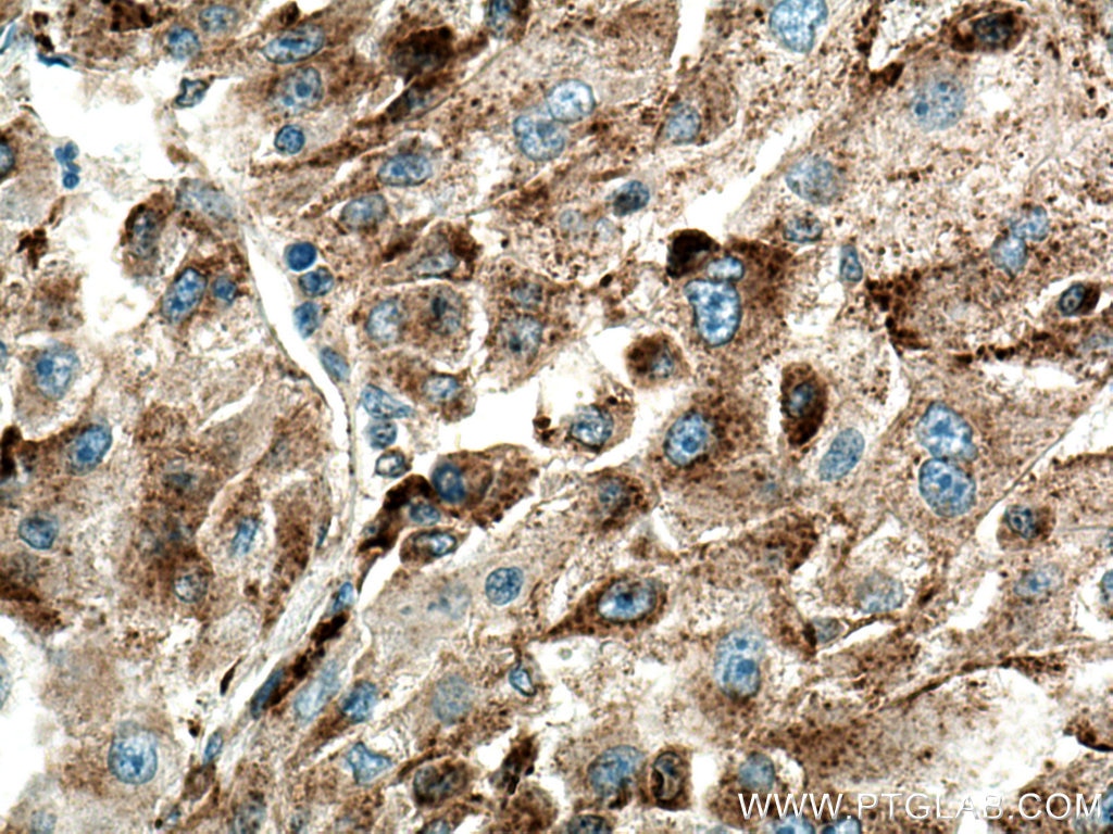 Immunohistochemistry (IHC) staining of human liver cancer tissue using Cathepsin L Polyclonal antibody (27952-1-AP)