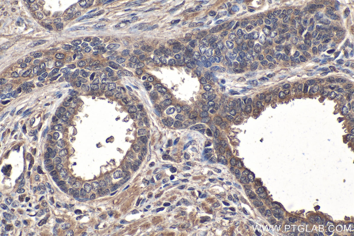 Immunohistochemistry (IHC) staining of human prostate cancer tissue using Cathepsin L Monoclonal antibody (66914-1-Ig)