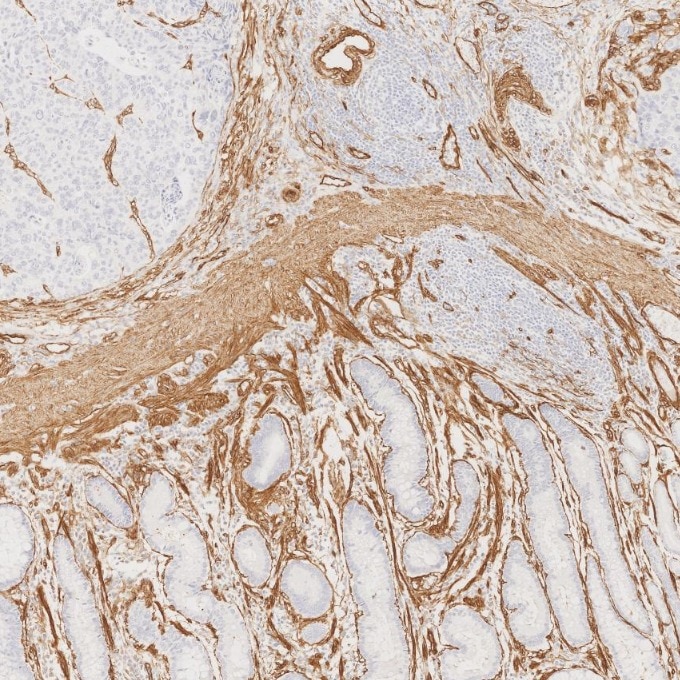 Immunohistochemistry (IHC) staining of human stomach cancer tissue using Caveolin-1 Recombinant monoclonal antibody (84044-1-RR)