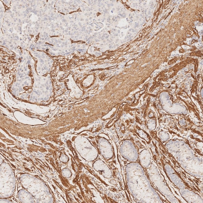 Immunohistochemistry (IHC) staining of human stomach cancer tissue using Caveolin-1 Recombinant monoclonal antibody (84044-1-RR)