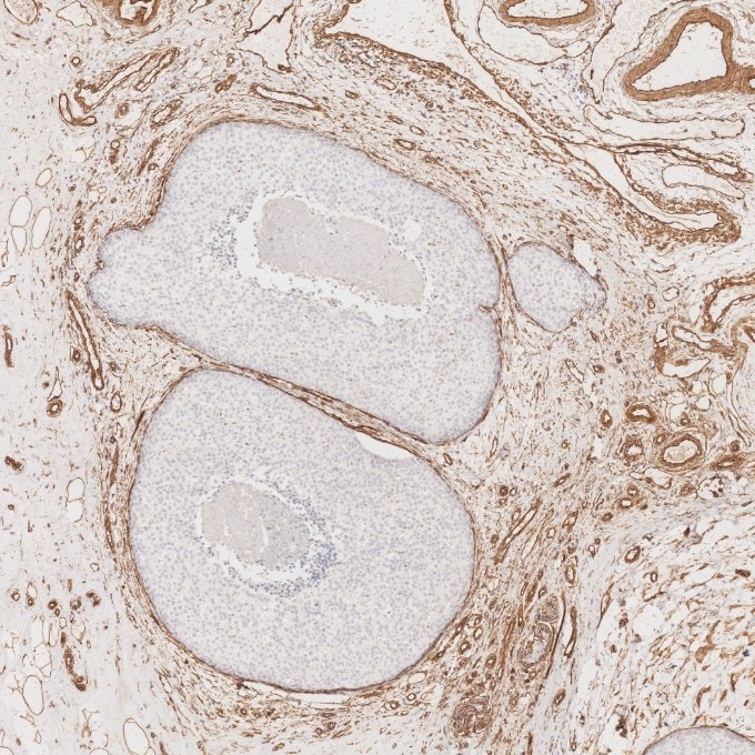 Immunohistochemistry (IHC) staining of human breast cancer tissue using Caveolin-1 Recombinant monoclonal antibody (84044-1-RR)