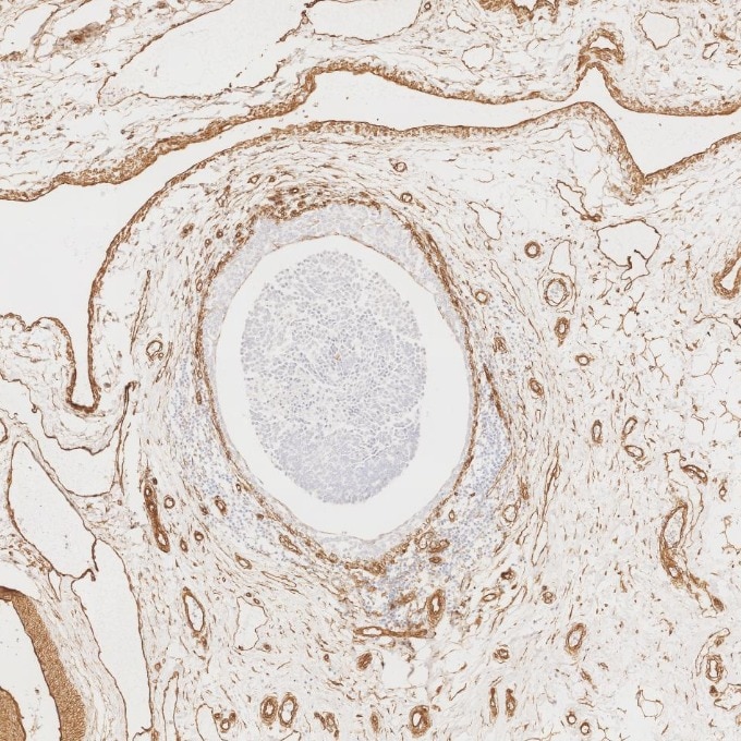 Immunohistochemistry (IHC) staining of human breast cancer tissue using Caveolin-1 Recombinant monoclonal antibody (84044-1-RR)