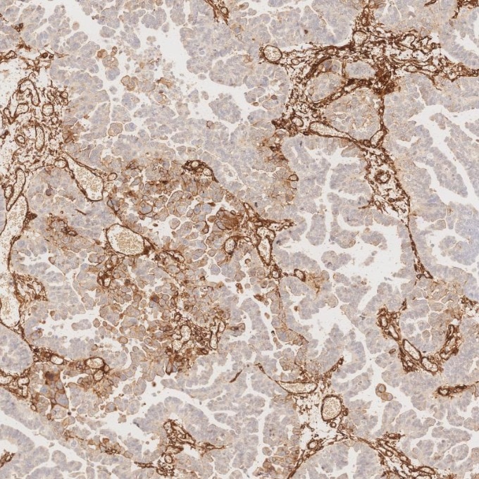 Immunohistochemistry (IHC) staining of human ovary cancer tissue using Caveolin-1 Recombinant monoclonal antibody (84044-1-RR)