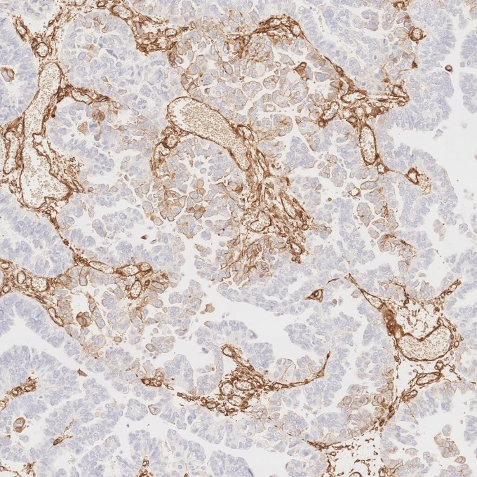 Immunohistochemistry (IHC) staining of human ovary cancer tissue using Caveolin-1 Recombinant monoclonal antibody (84044-1-RR)
