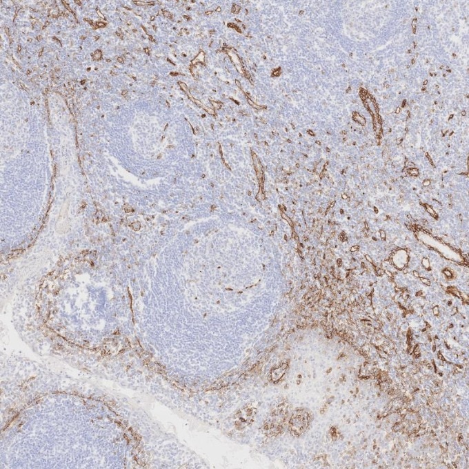 Immunohistochemistry (IHC) staining of human tonsillitis tissue using Caveolin-1 Recombinant monoclonal antibody (84044-1-RR)