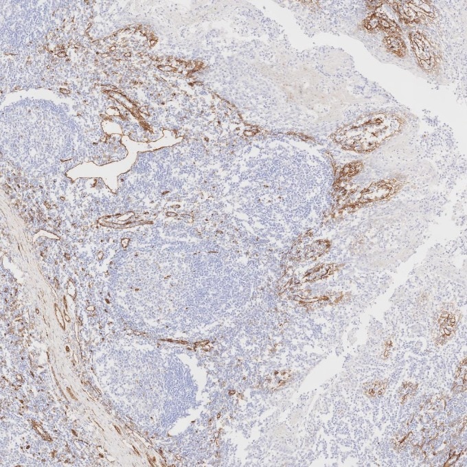 Immunohistochemistry (IHC) staining of human tonsillitis tissue using Caveolin-1 Recombinant monoclonal antibody (84044-1-RR)