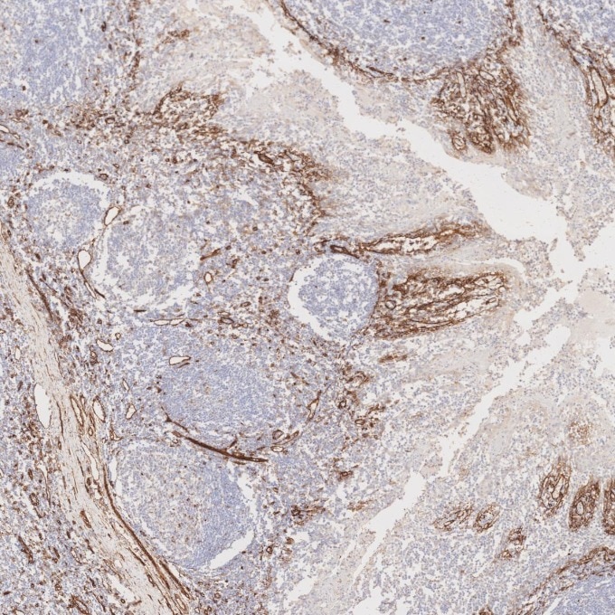 Immunohistochemistry (IHC) staining of human tonsillitis tissue using Caveolin-1 Recombinant monoclonal antibody (84044-1-RR)