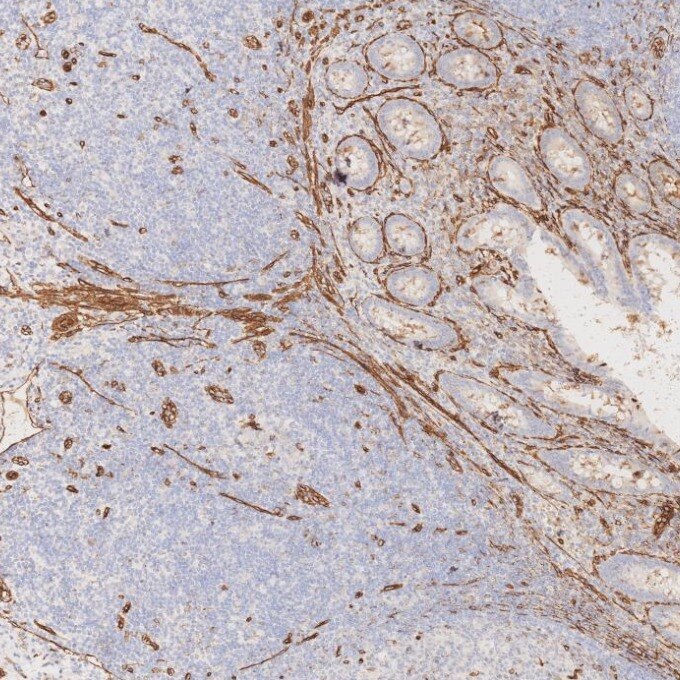 Immunohistochemistry (IHC) staining of human appendicitis tissue using Caveolin-1 Recombinant monoclonal antibody (84044-1-RR)