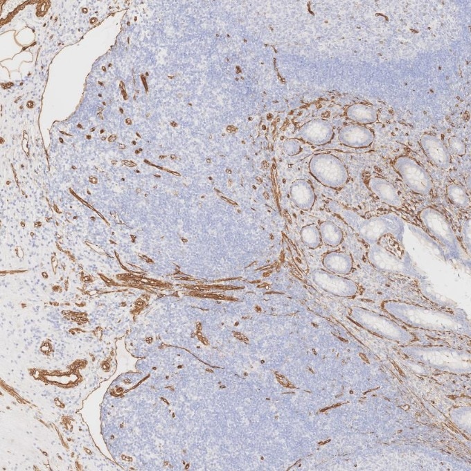 Immunohistochemistry (IHC) staining of human appendicitis tissue using Caveolin-1 Recombinant monoclonal antibody (84044-1-RR)