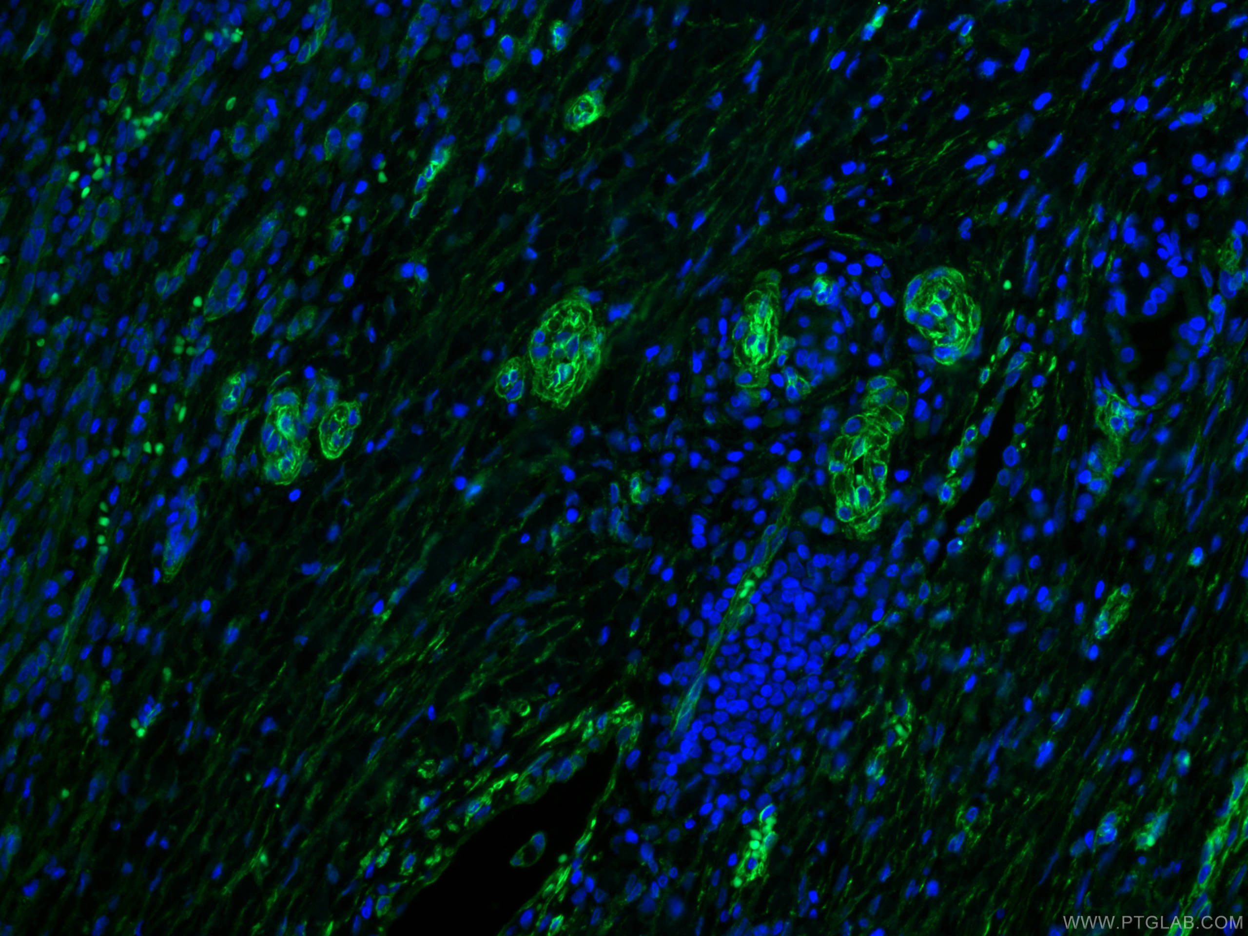 Immunofluorescence (IF) / fluorescent staining of human liver cancer tissue using CoraLite® Plus 488-conjugated Caveolin-1 Monoclona (CL488-66067)