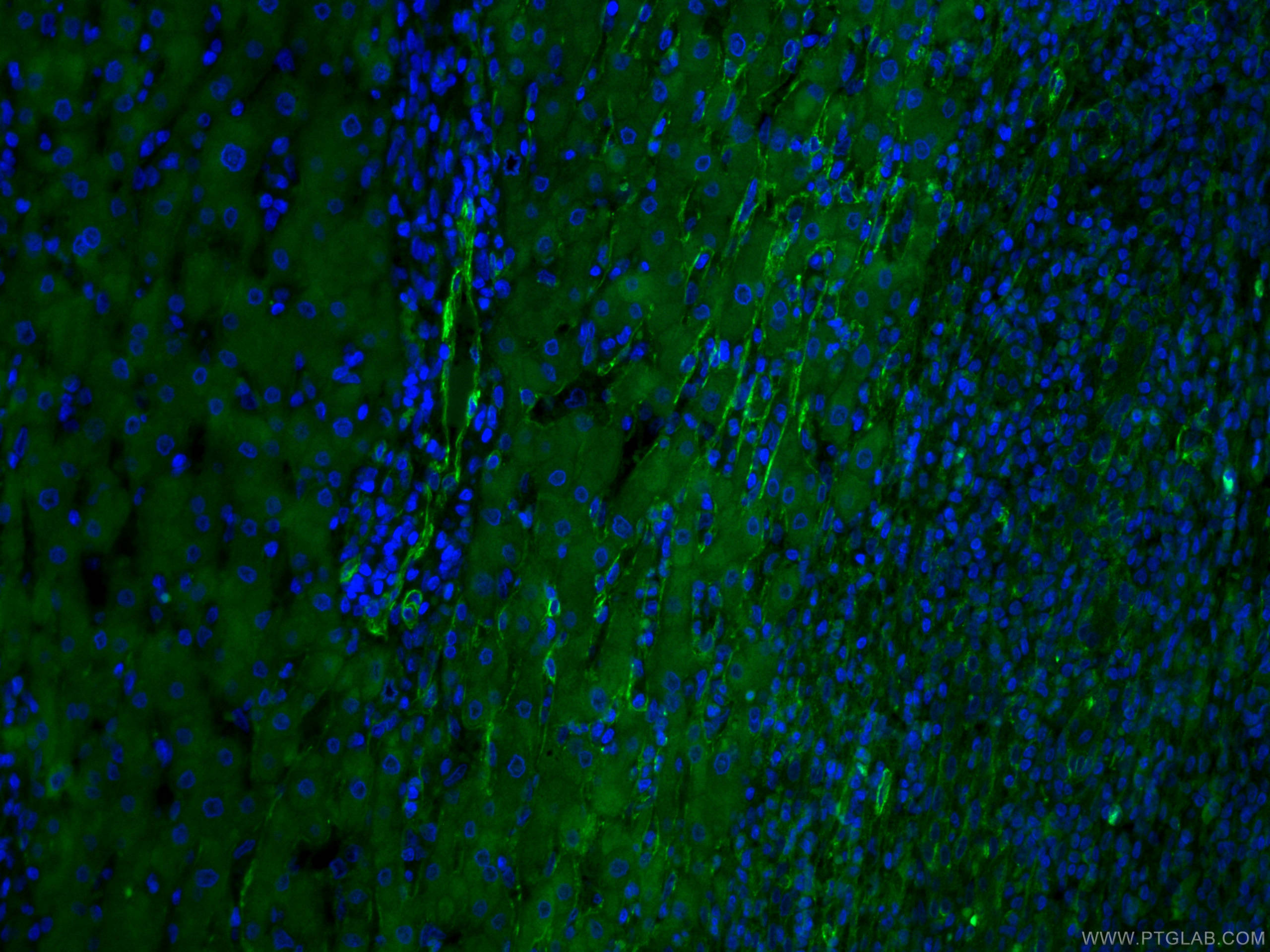 Immunofluorescence (IF) / fluorescent staining of human liver cancer tissue using CoraLite® Plus 488-conjugated Caveolin-1 Monoclona (CL488-66067)