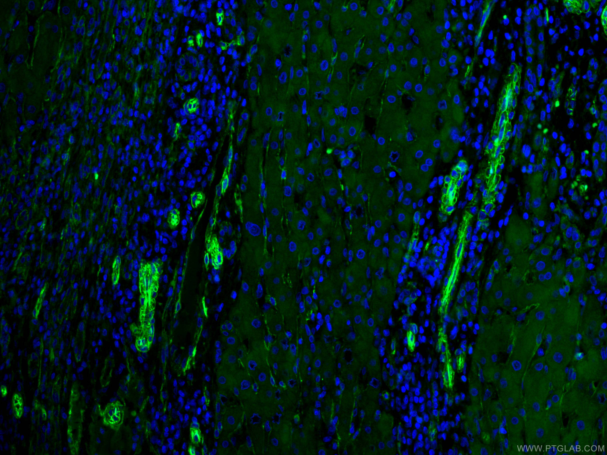 Immunofluorescence (IF) / fluorescent staining of human liver cancer tissue using CoraLite® Plus 488-conjugated Caveolin-1 Monoclona (CL488-66067)