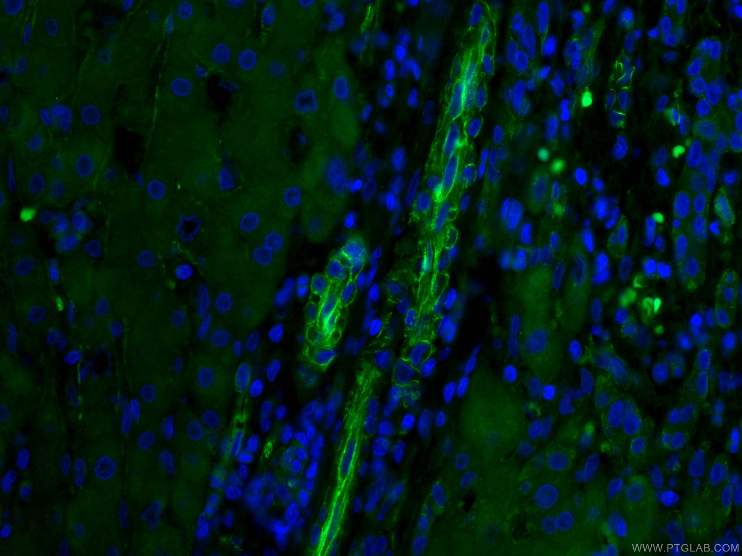 Immunofluorescence (IF) / fluorescent staining of human liver cancer tissue using CoraLite® Plus 488-conjugated Caveolin-1 Monoclona (CL488-66067)