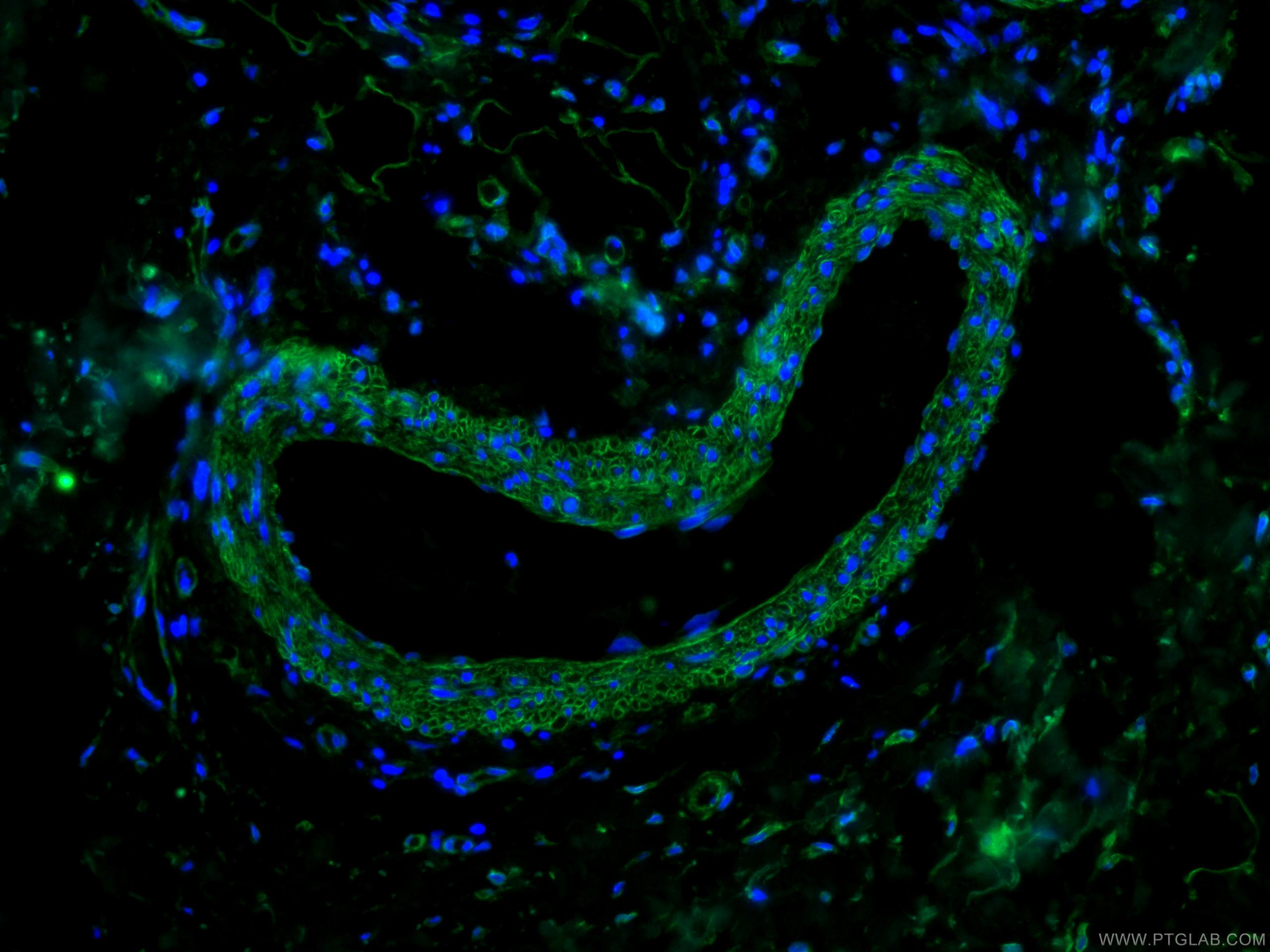 Immunofluorescence (IF) / fluorescent staining of human skin cancer tissue using CoraLite® Plus 488-conjugated Caveolin-1 Monoclona (CL488-66067)