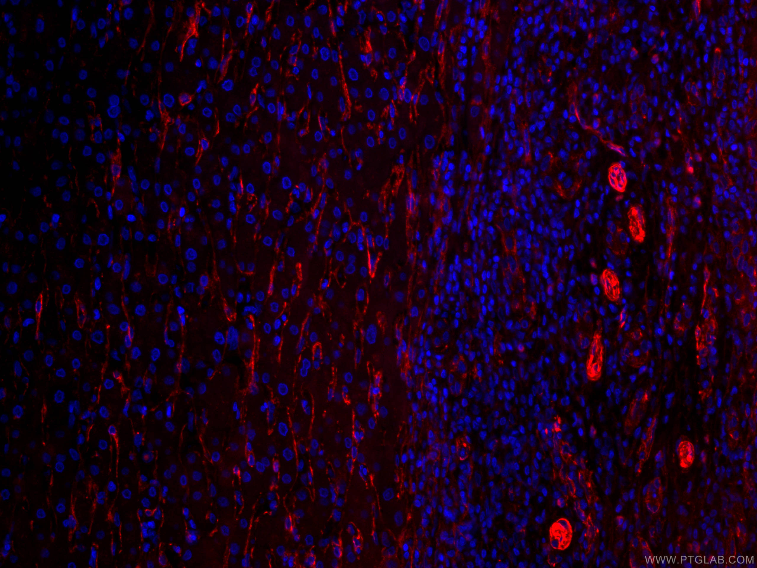 Immunofluorescence (IF) / fluorescent staining of human liver cancer tissue using CoraLite®594-conjugated Caveolin-1 Monoclonal anti (CL594-66067)