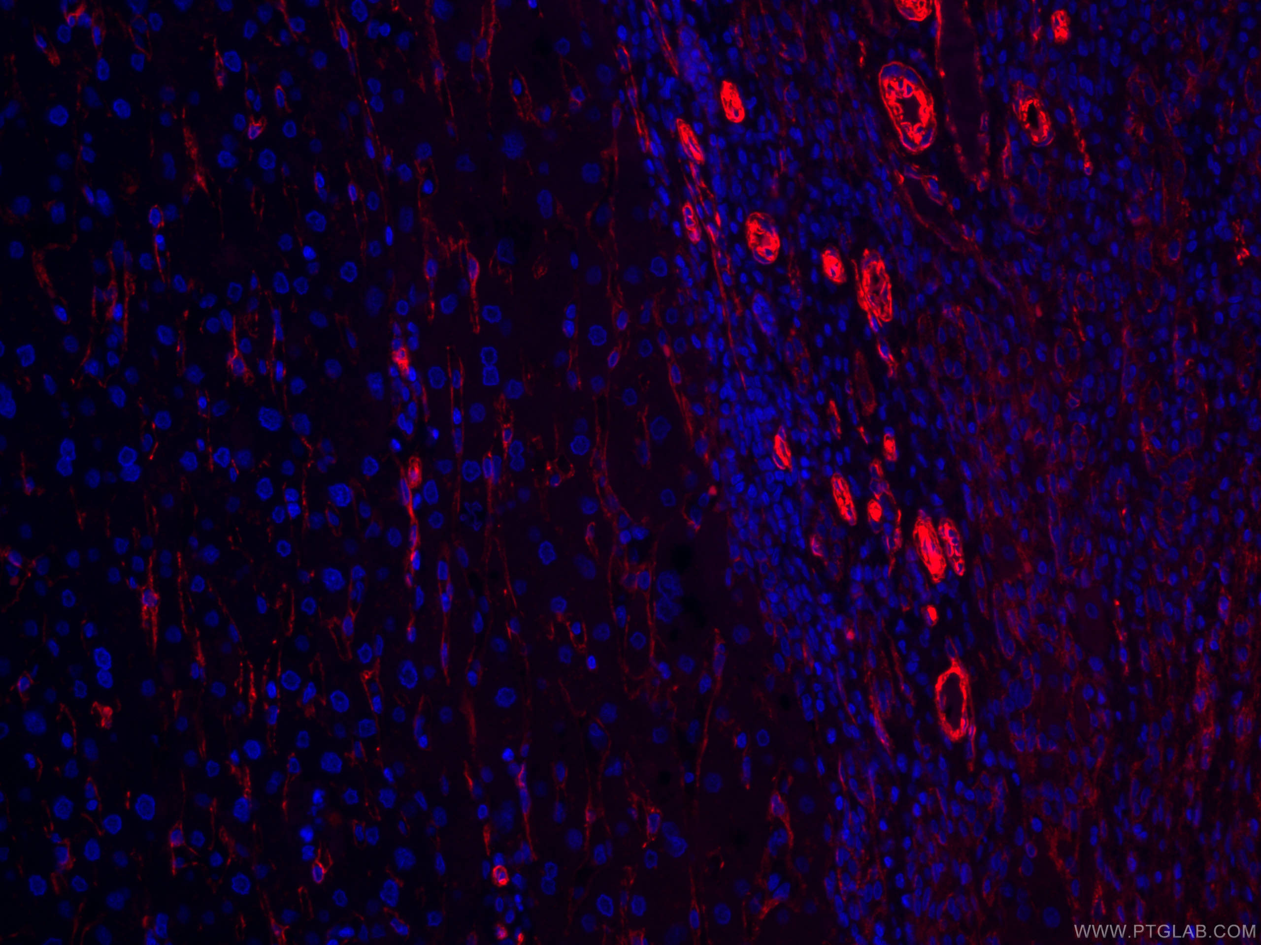 Immunofluorescence (IF) / fluorescent staining of human liver cancer tissue using CoraLite®594-conjugated Caveolin-1 Monoclonal anti (CL594-66067)