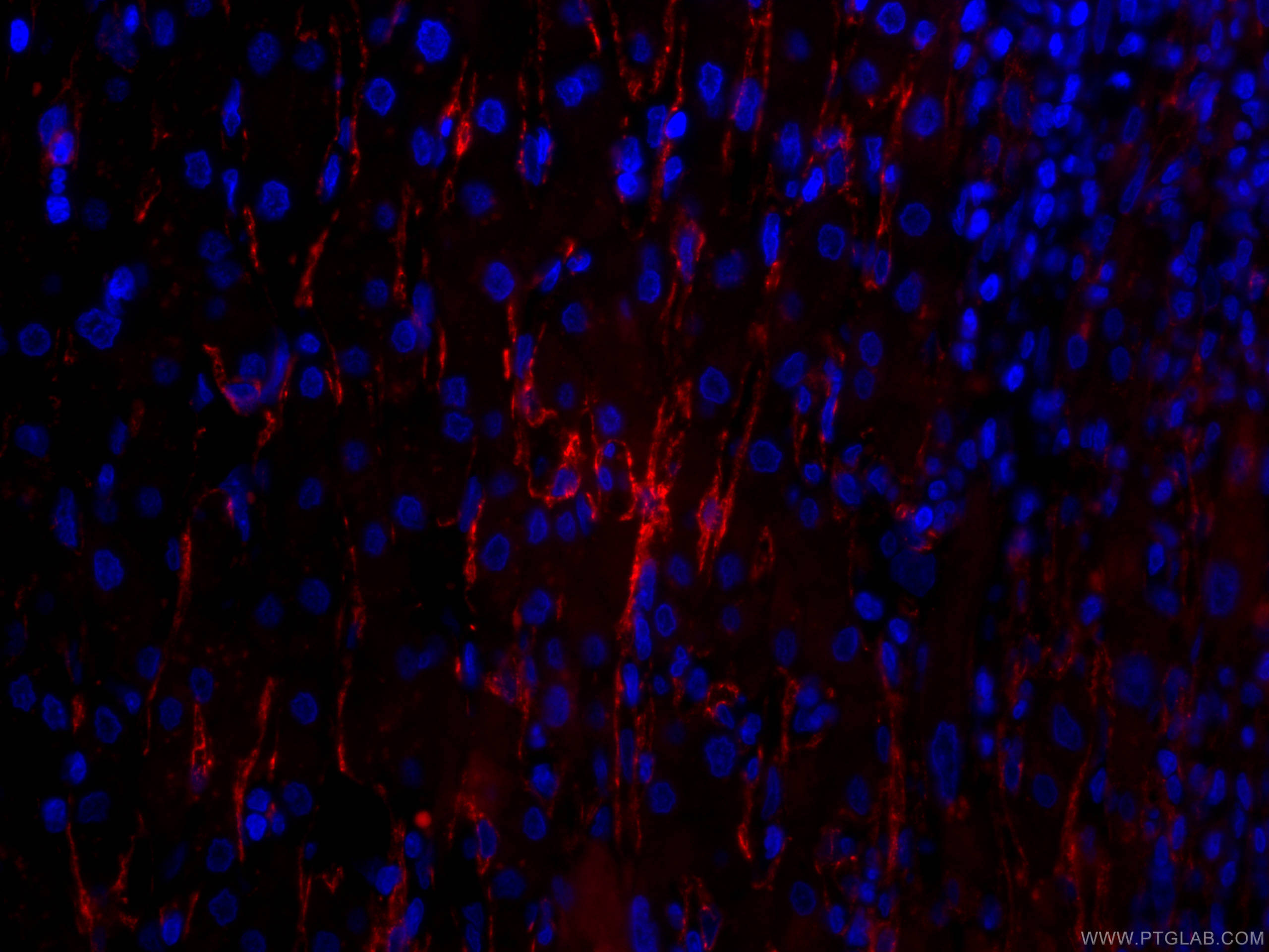 Immunofluorescence (IF) / fluorescent staining of human liver cancer tissue using CoraLite®594-conjugated Caveolin-1 Monoclonal anti (CL594-66067)