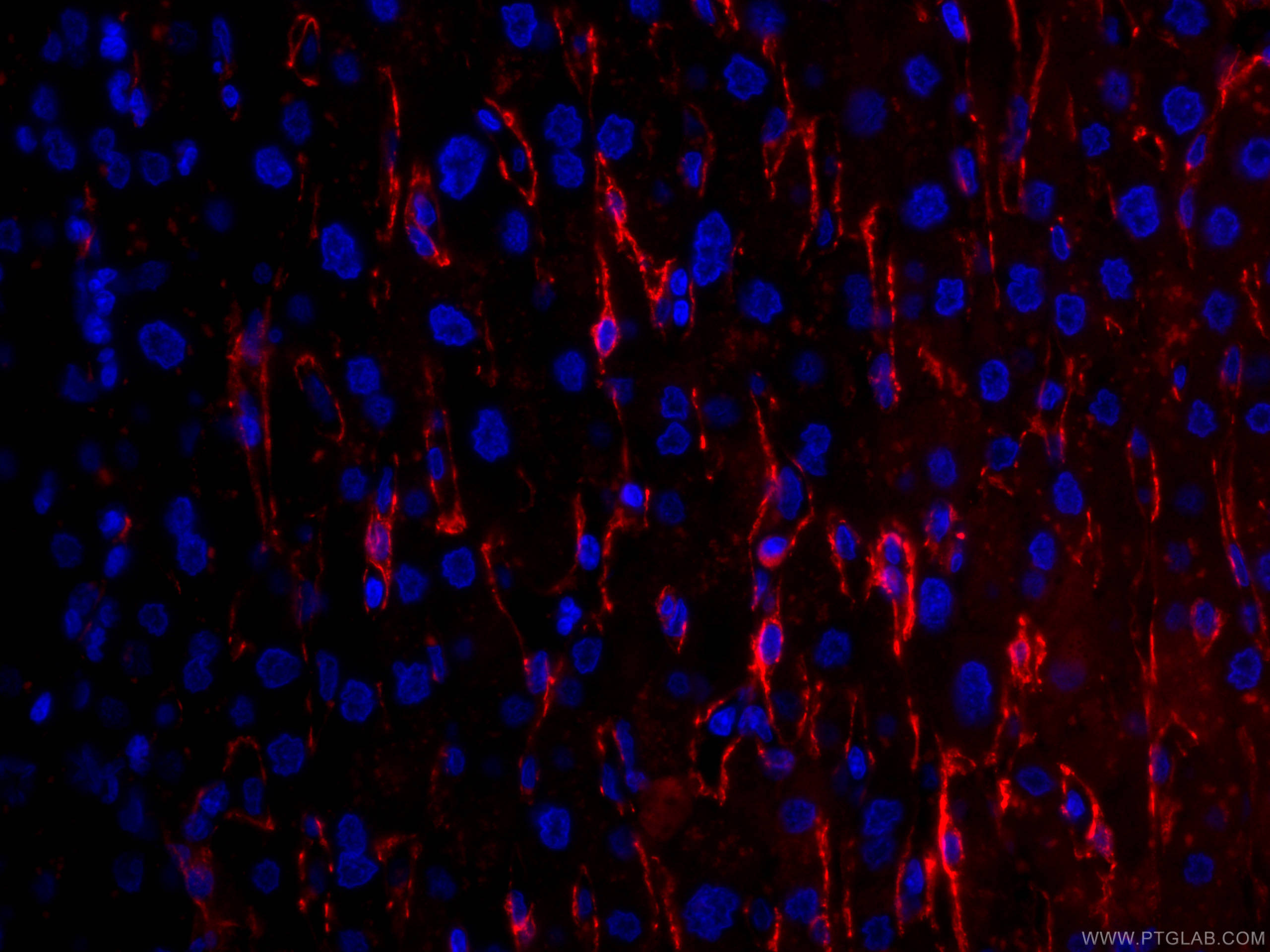 Immunofluorescence (IF) / fluorescent staining of human liver cancer tissue using CoraLite®594-conjugated Caveolin-1 Monoclonal anti (CL594-66067)