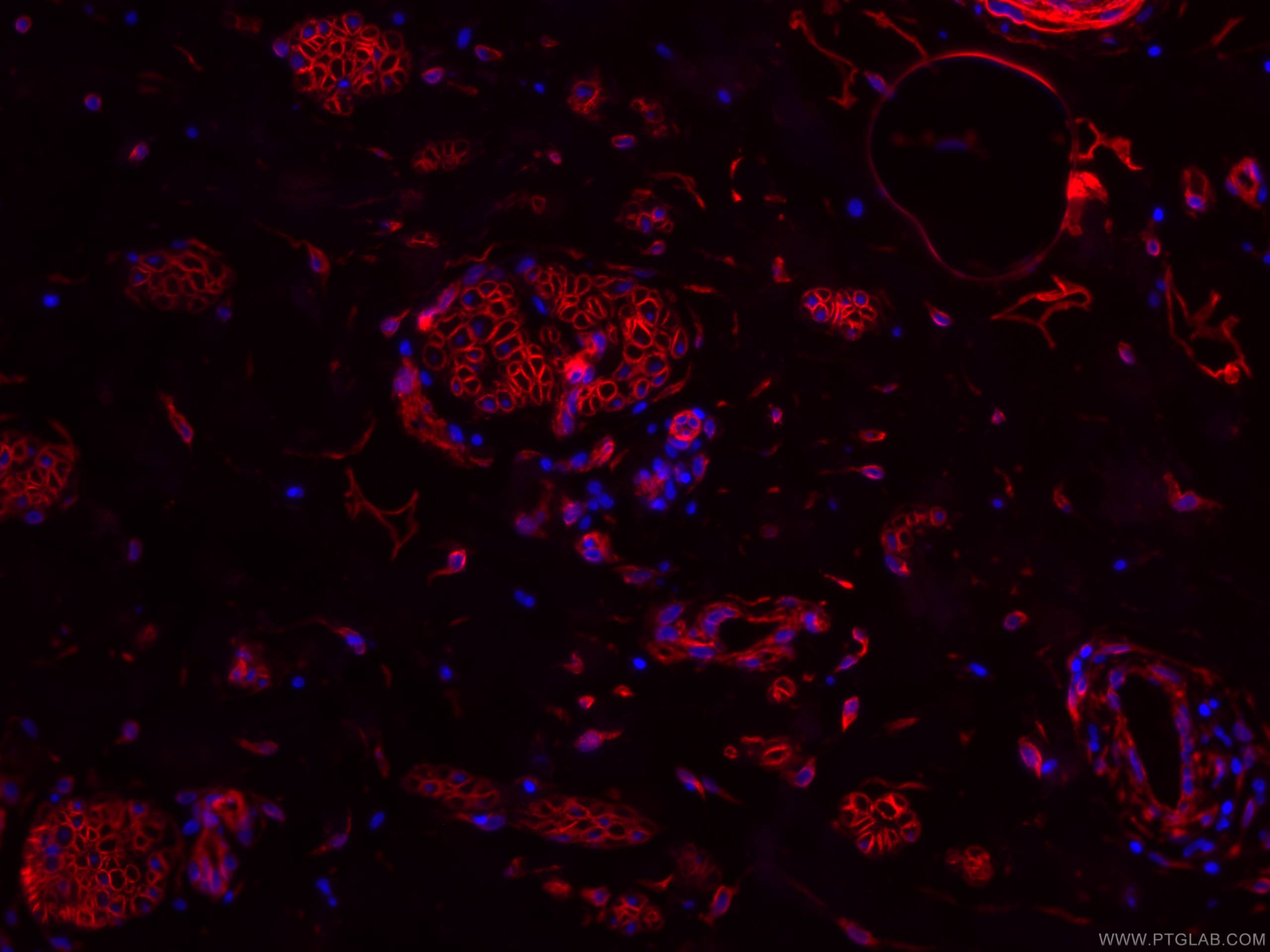 Immunofluorescence (IF) / fluorescent staining of human skin cancer tissue using CoraLite®594-conjugated Caveolin-1 Monoclonal anti (CL594-66067)