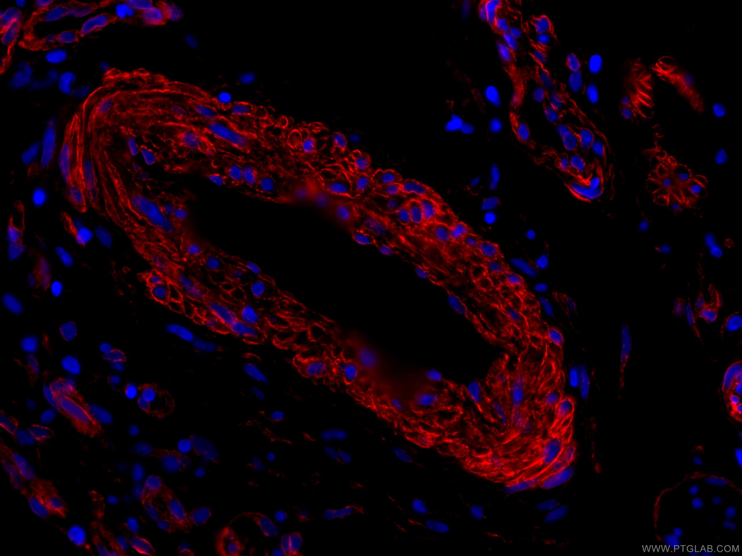 Immunofluorescence (IF) / fluorescent staining of human skin cancer tissue using CoraLite®594-conjugated Caveolin-1 Monoclonal anti (CL594-66067)