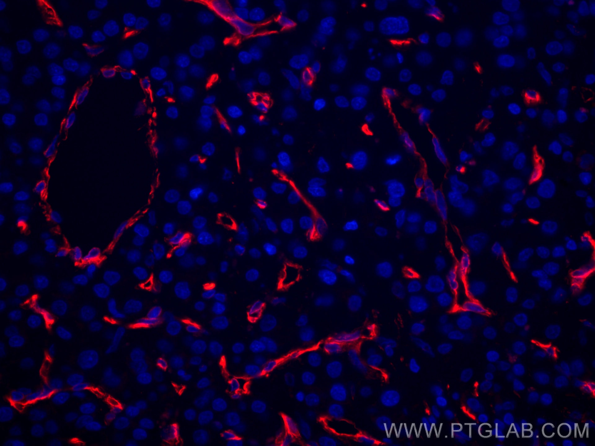 Immunofluorescence (IF) / fluorescent staining of human liver cancer tissue using CoraLite®594-conjugated Caveolin-1 Monoclonal anti (CL594-66067)