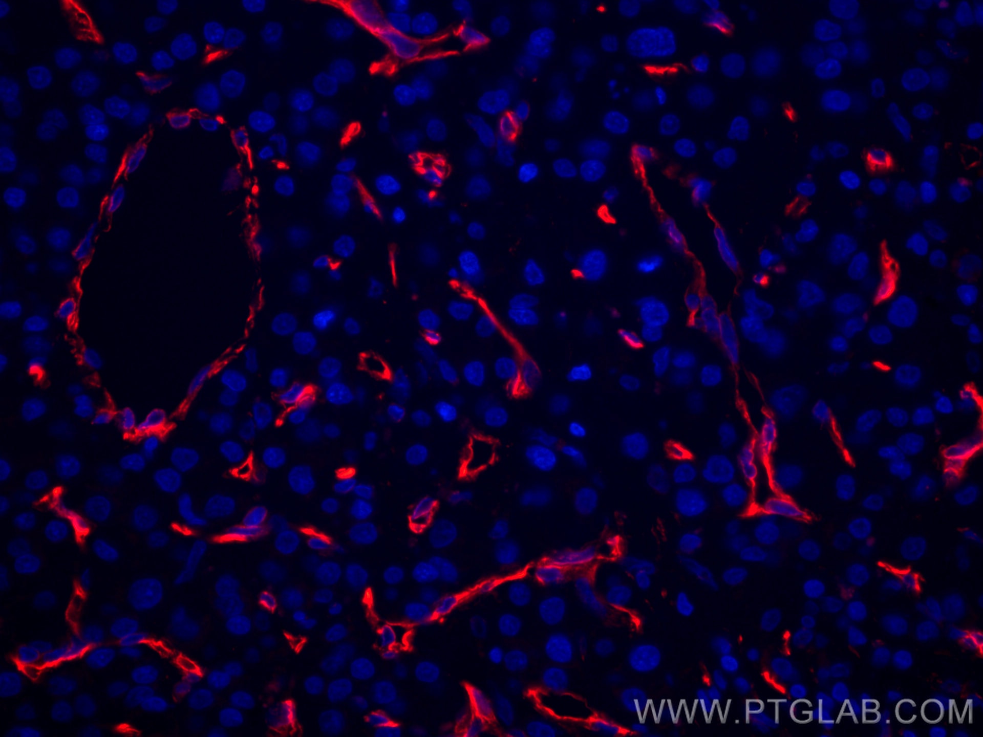 IF Staining of human liver cancer using CL594-66067