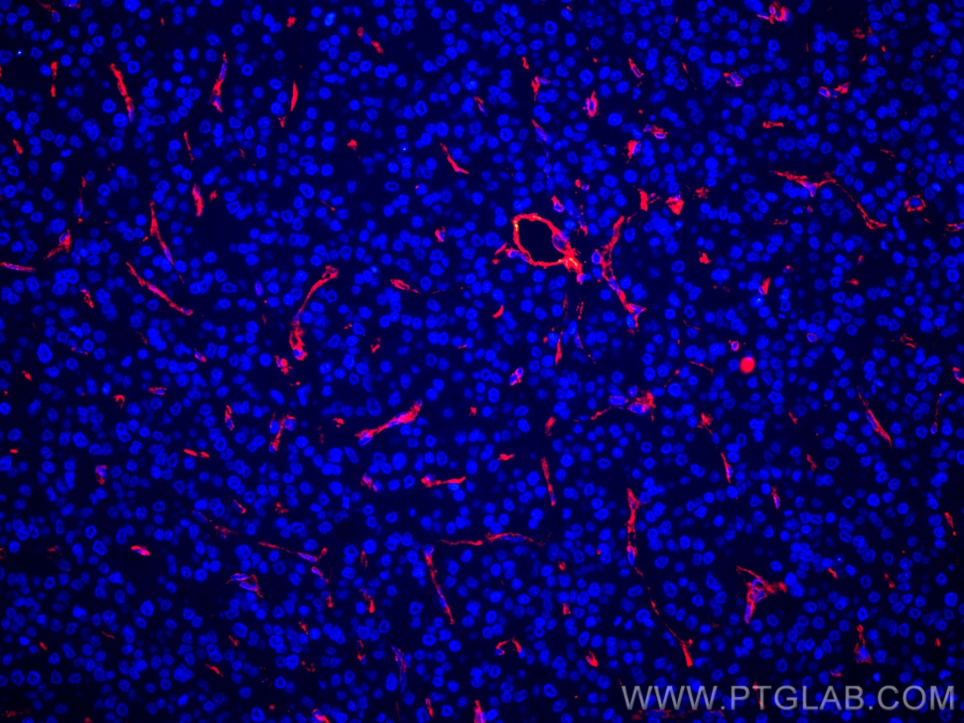 Immunofluorescence (IF) / fluorescent staining of human liver cancer tissue using CoraLite®594-conjugated Caveolin-1 Monoclonal anti (CL594-66067)